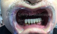 Восстановление зубов на верхней и нижней челюсти - Фотография 1
